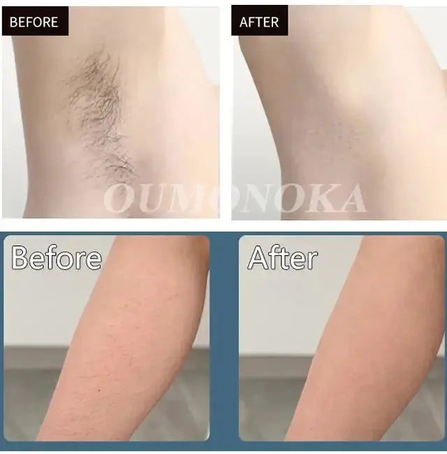 Épilateur laser permanent à 999 999 flashs pour bikini, appareil d&