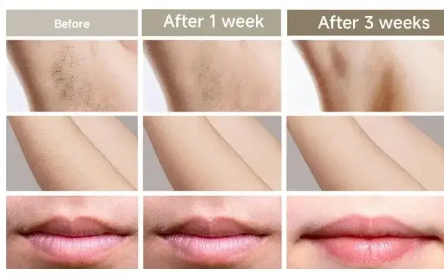 Épilateur laser permanent à 999 999 flashs pour bikini, appareil d&