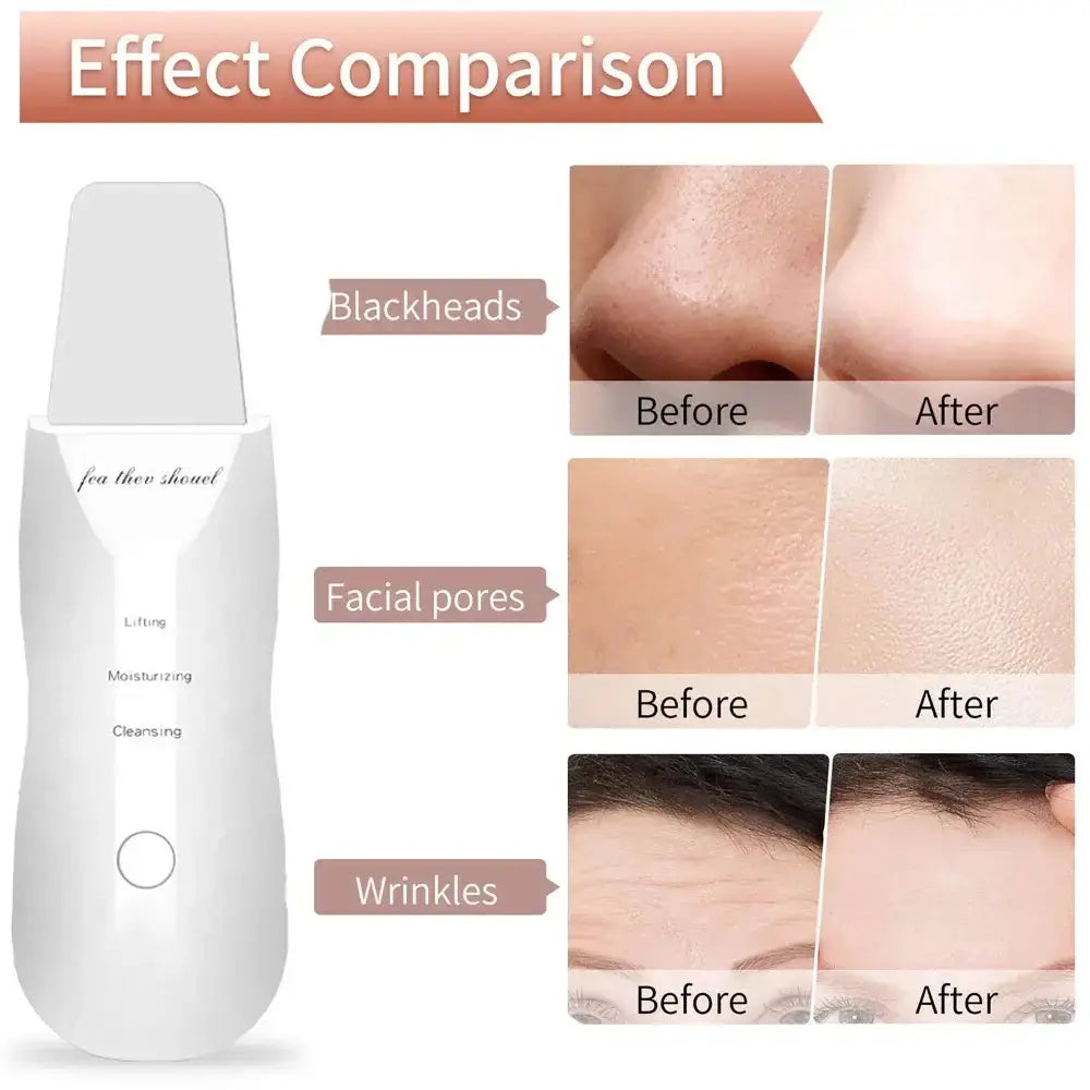 Before and after effects of an electric facial exfoliator for blackheads, facial pores, and wrinkles.
