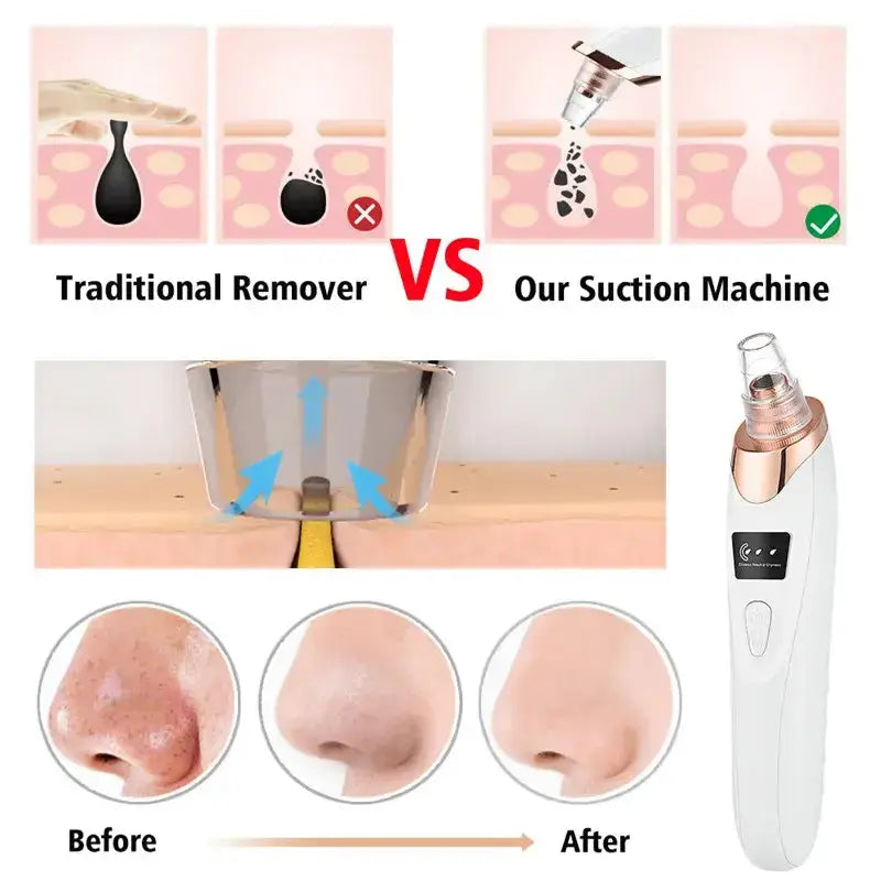 Comparison of traditional blackhead removers vs. USB-rechargeable suction machine, showing before and after results.