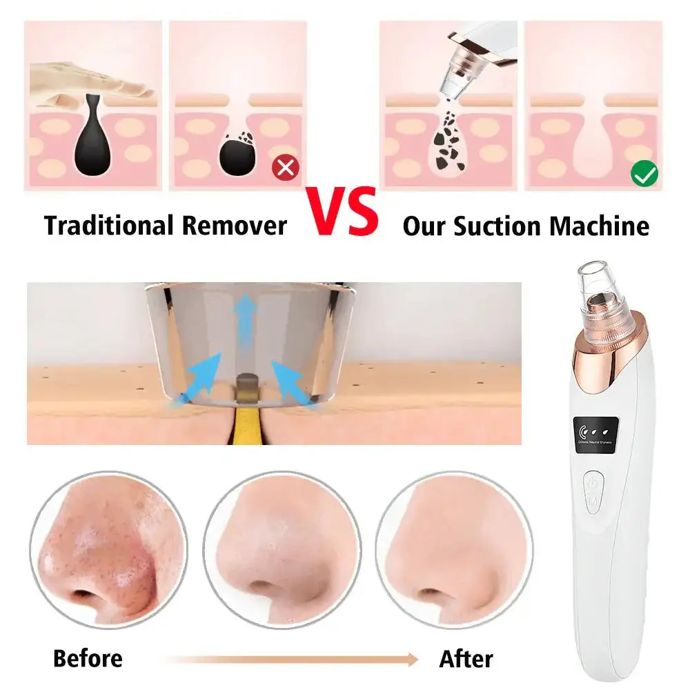 Comparison of traditional remover vs suction machine for blackhead and acne extraction, showing before and after results.