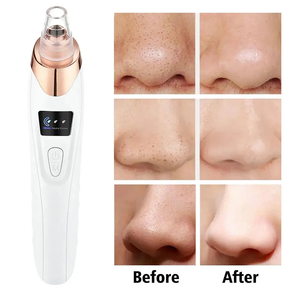 Extracteur de points noirs USB DearBeauty, avant-après nettoyage du visage et acné.