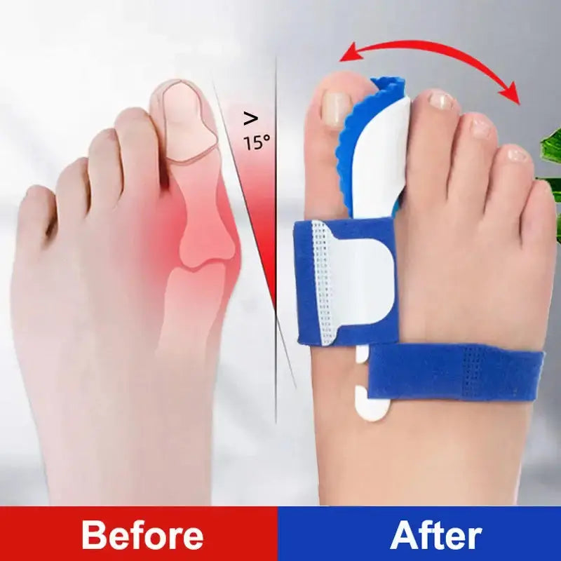 &quot;Hallux Valgus orthopedic bunion corrector, night toe brace and splints for bunions pain relief and toe alignment&quot;