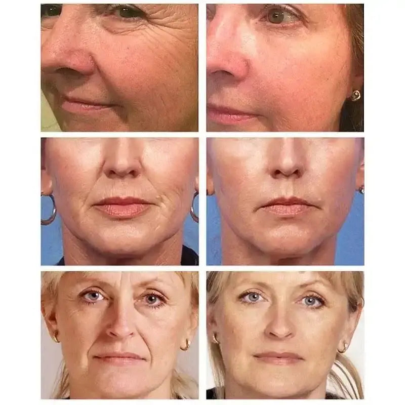 Before and after results showcasing the effectiveness of anti-aging serum for reducing wrinkles and fine lines.